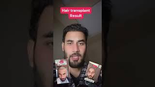 My hair transplant journey 4 months post #hairtransplant  ‍