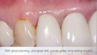 Dental Implants By Dr Gurs Sehmi