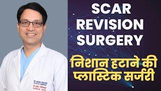 SCAR REVISION SURGERY I  निशान मिटाने की प्लास्टिक सर्जरी