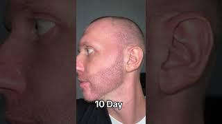 Beard Transplant Result | Beard Transplant Before and After 5000 Grafts Result 12 months timelapse