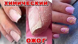 CHEMICAL BURN  Cracked skin  Complicated hands  Manicure