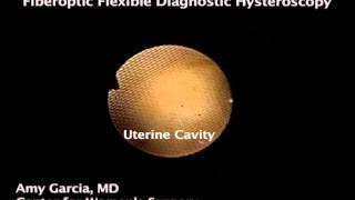 Cesarean scar defect diagnosed on fiberoptic flexible hysteroscopy