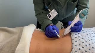 Dry Needling Demonstration | Oakdale ObGyn