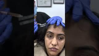 Female Hair PRP Treatment at Cara Clinic | Hair PRP