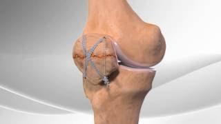 Patella Fracture Repair