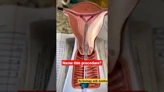 #shorts #short #shortsvideo #viralshorts #neet #aiims #biology #physicswallah #iud  #mbbs #doctor