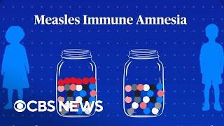 Doctor explains how the measles virus affects the immune system