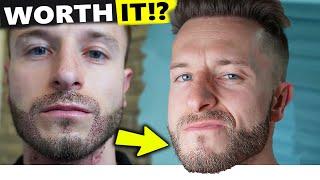 Regretting My Beard Transplant!? 1 Year before and after Result!