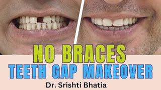 NO BRACES Teeth Gap Makeover; Dr. Srishti Bhatia #smilemakeover