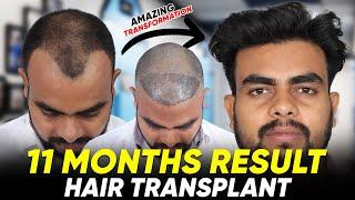 Hair Transplant in India | Best Results & Cost of Hair Transplant in India