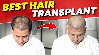 Hair Transplant in Surat | Best Results & Cost of Hair Transplant in Surat