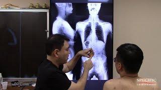 Banker from Hong Kong to NYC with back pain and tight shoulders - Dr Suh Chiropractor