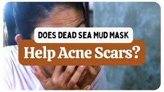 Does Dead Sea Mud Mask Help Acne Scars?
