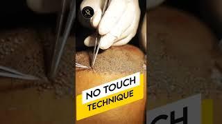 No Roots Touch Technique Hair Transplant | #hairtransplantation