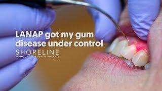 Treat periodontal disease with less pain. Dr. Urbanski explains the LANAP procedure.