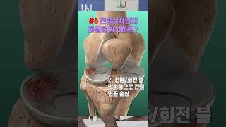 [유앤제이병원] #6 #무릎 #전방십자인대 #파열 #방치하면 ?