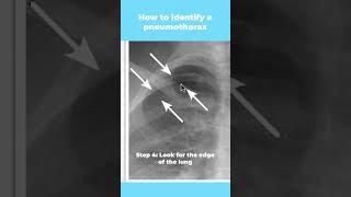 How to identify a pneumothorax (in 5 easy steps) #shorts