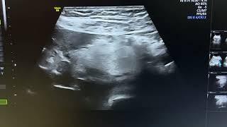 Ultrasound of panniculitis