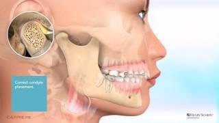 Carriere® Motion™ Appliance for Class II Patient Education Animation