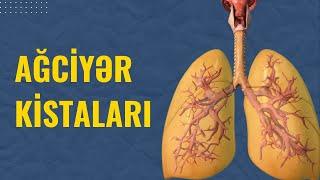 AĞCİYƏR KİSTALARI. Nə vaxt əməliyyat olunmalıdır? | Toğrul Ömərov