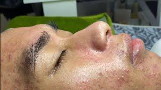 Acne treatment for Spa Linh Mun 2024 #152