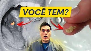 Cáseos Amigdalianos: Como saber você tem?