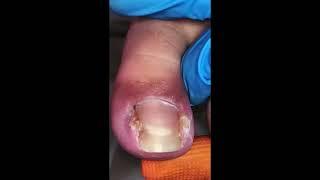 Massive Removal Infected Toenail!