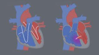 Congenital Heart Defects - What is a CHD?