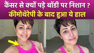 Hina Khan Breast Cancer Treatment के दौरान Body Scars पर Emotional Post Viral, Fans Sad Reaction