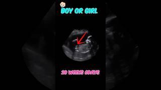 20 weeks | baby boy or baby girl  | #baby #ultrasound #shorts