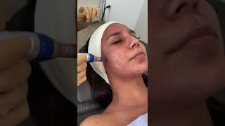 Microneedling  | Evoclinic