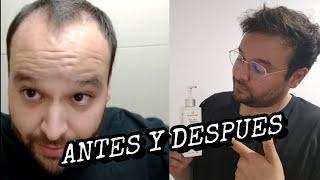 6 meses usando Shampoo anti caída / ANTES Y DESPUÉS