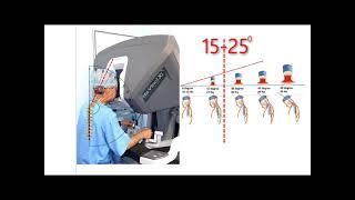 #341 Vesicoscopic Robotic Assisted Ureteric Reimplantation in Children... Dr. M. S. Ansari