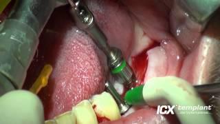 Dental Implantat Zahn 36 und 37