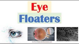 Eye Floaters (Vitreous Floaters) | Causes, Risk Factors, Associated Conditions, Diagnosis, Treatment