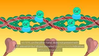 Medical Specialists Associates - Using Troponin to Screen for STEMI and NSTEMI