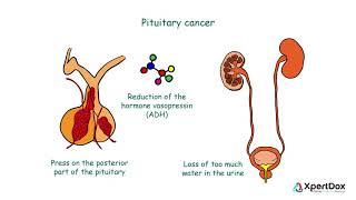 What is Pituitary cancer?