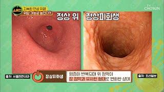 위 기능 저하, 위암의 전 단계 장상피화생..이란??