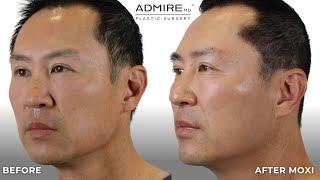 Dr. Admire Discusses Sciton MOXI at AdmireMD Skin Clinic, Scottsdale, AZ