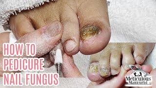 How to do a Pedicure on a Bad Case of Nail Fungus transformation