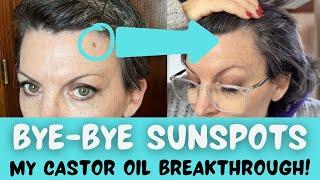 Sunspot SOS | The Castor Oil Hack That Saved My Skin