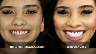 Affordable Smile Makeover w/No Dentist ! New Online Dental Veneers by Brighter Image Lab