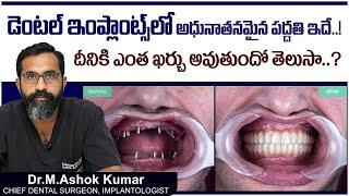 ఇంప్లాంట్స్ లో కొత్త పద్దతి || Best Dental Implant Treatment in Telugu || Eledent Dental Hospitals