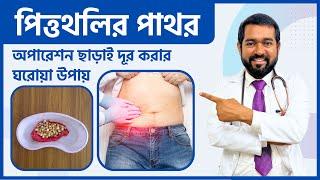 অপারেশন ছাড়াই পিত্তথলি বা Gallbladder এর পাথর কিভাবে দূর করবেন? ঘরোয়া ও সহজ সমাধান। Dr Haque