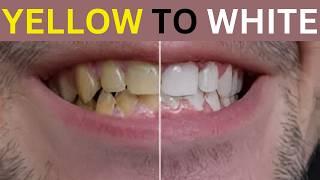 Teeth Whitening Revealed: Pros, Cons, and Expert Tips for Best Results"