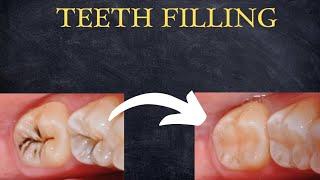 Teeth Filling Procedure