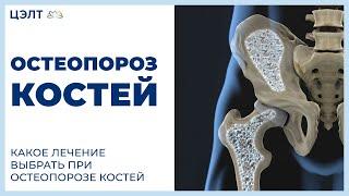 Остеопороз костей.  Какое лечение выбрать при остеопорозе костей. ЦЭЛТ