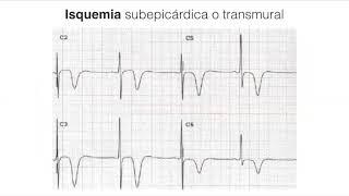 VIDEOCONFERENCIA DE CARDIOPATIA ISQUEMICA