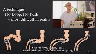 Colonoscopy Insertion Technique with Mikoto Model: How to avoid loops during colonoscopy?