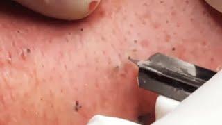 ENJOY YOUR DAY WITH GA SPA PART VI #relaxing  #blackheads